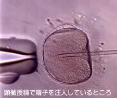 顕微受精